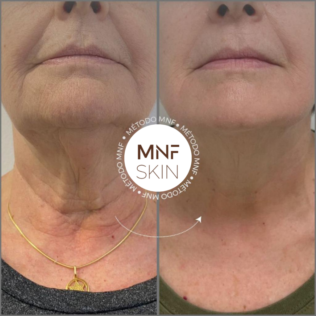 antes e depois MNF metodo de naturalização facial em belo horizonte