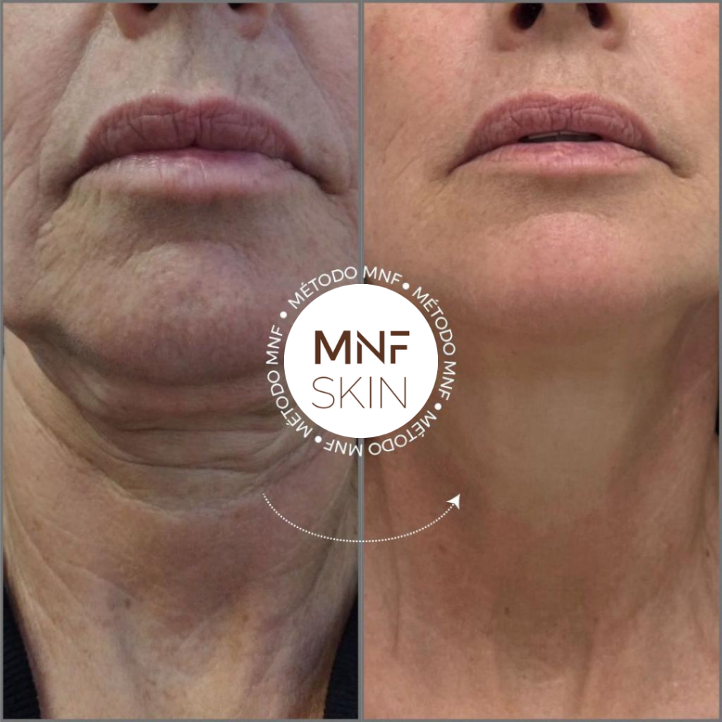 antes e depois MNF metodo de naturalização facial em belo horizonte