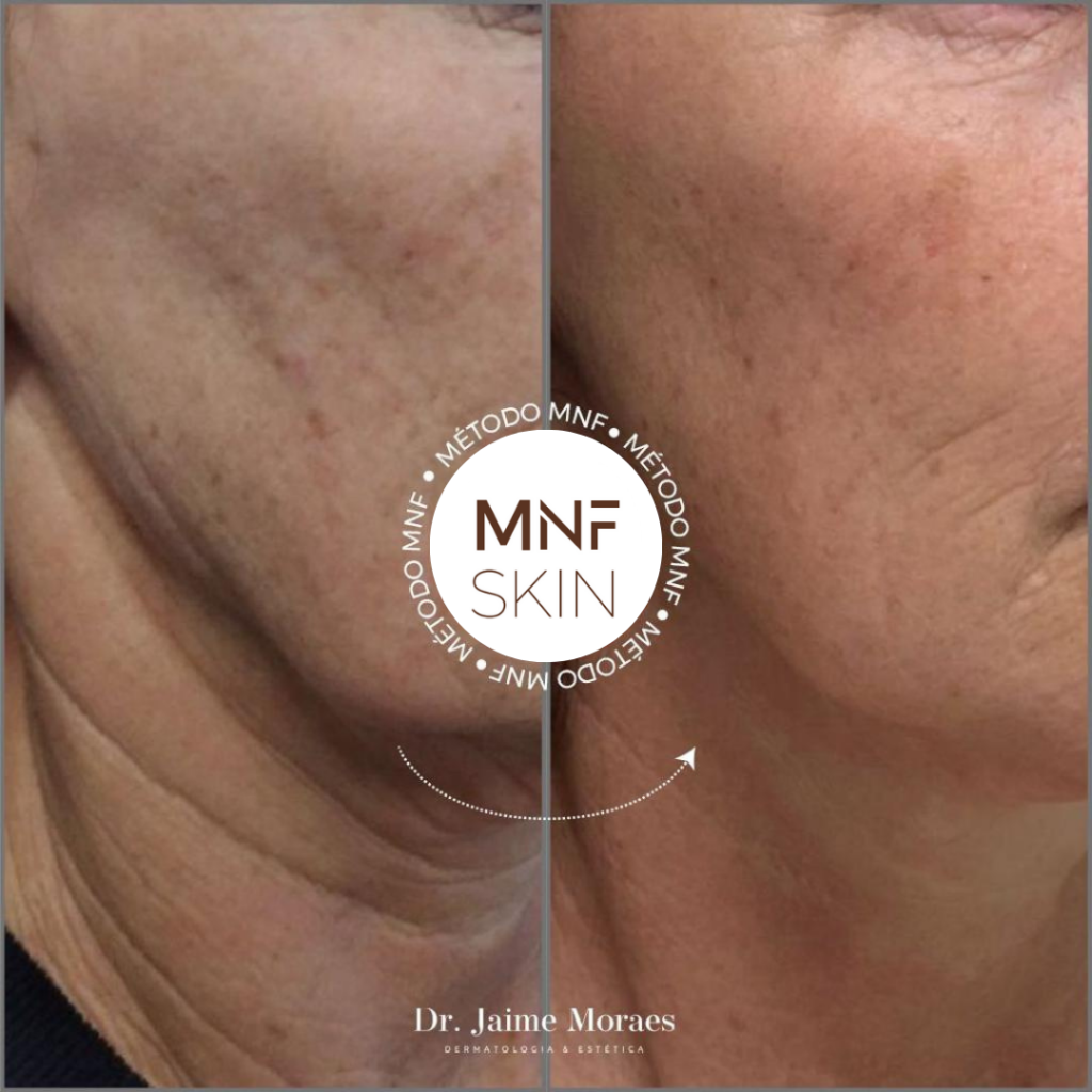 antes e depois MNF metodo de naturalização facial em belo horizonte