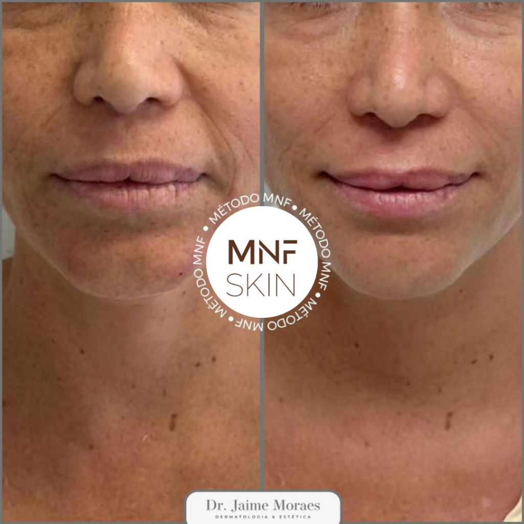antes e depois MNF metodo de naturalização facial em belo horizonte